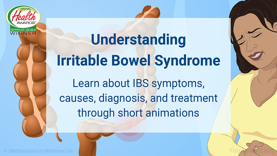 Understanding Irritable Bowel Syndrome. Learn about IBS symptoms, causes, diagnosis, and treatment through short animations.