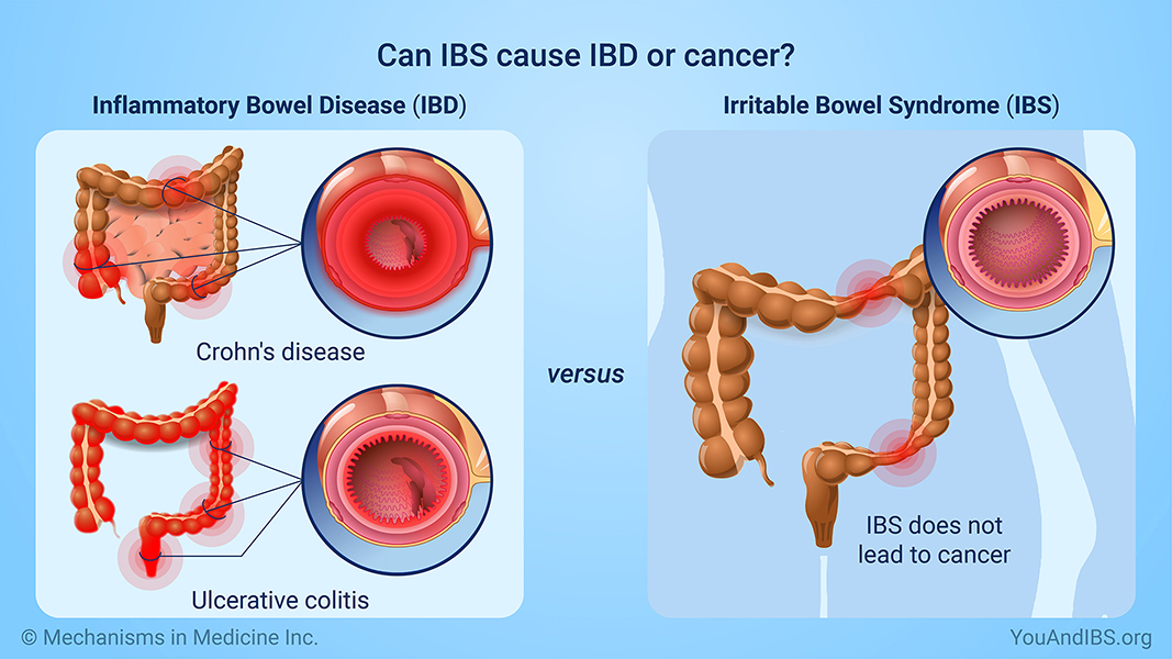Can IBS cause IBD or cancer?