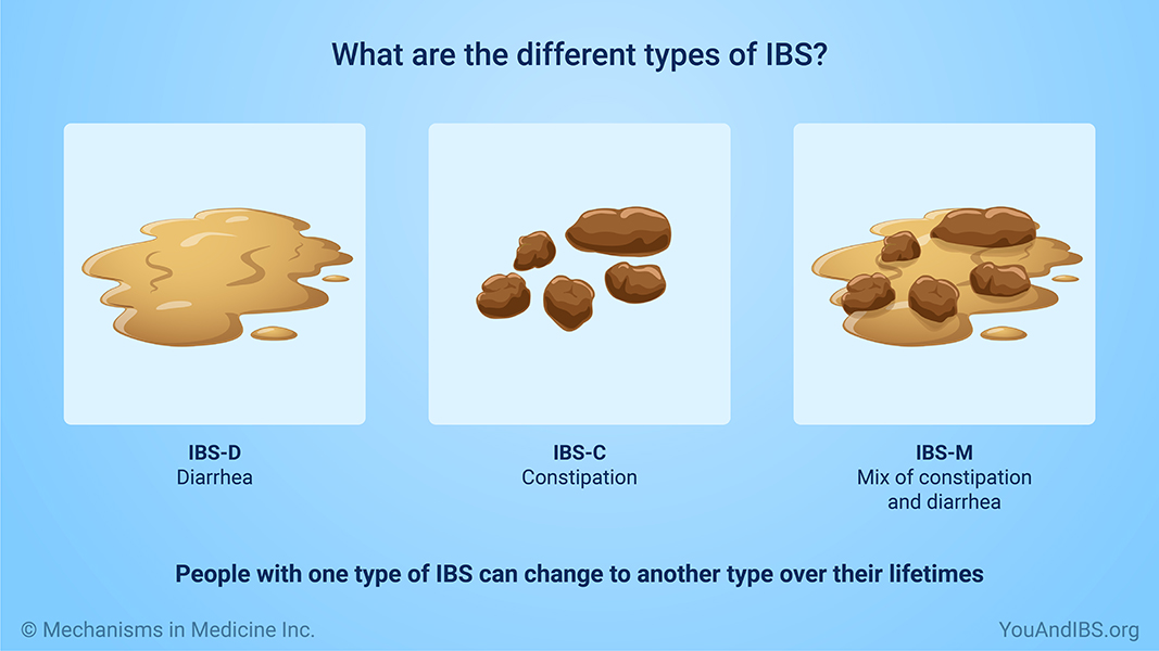What are the different types of IBS?