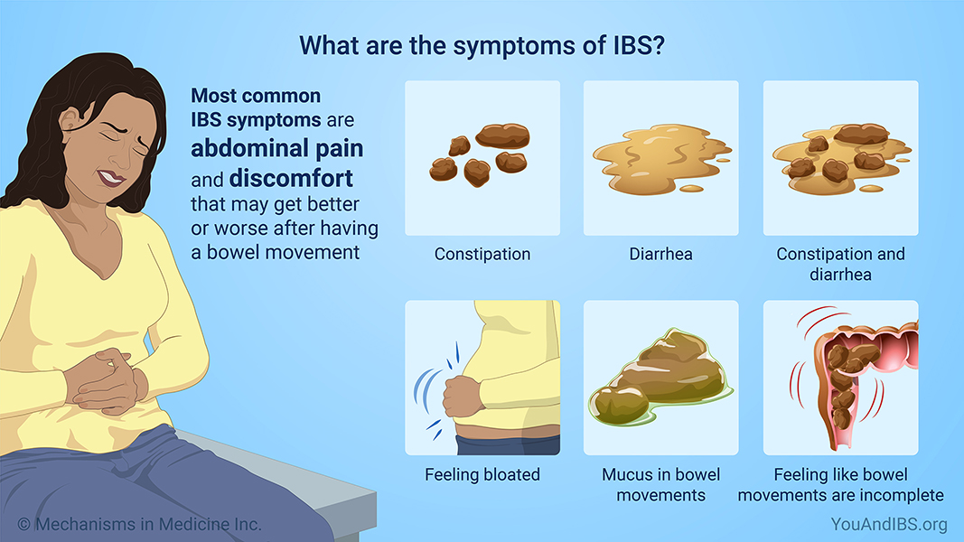 What are the symptoms of IBS?